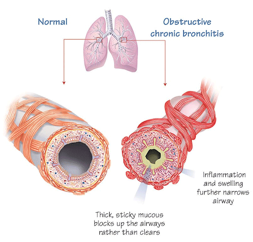 COPD và đặc điểm bệnh COPD 1