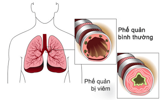 Hẹp đường dẫn khí COPD