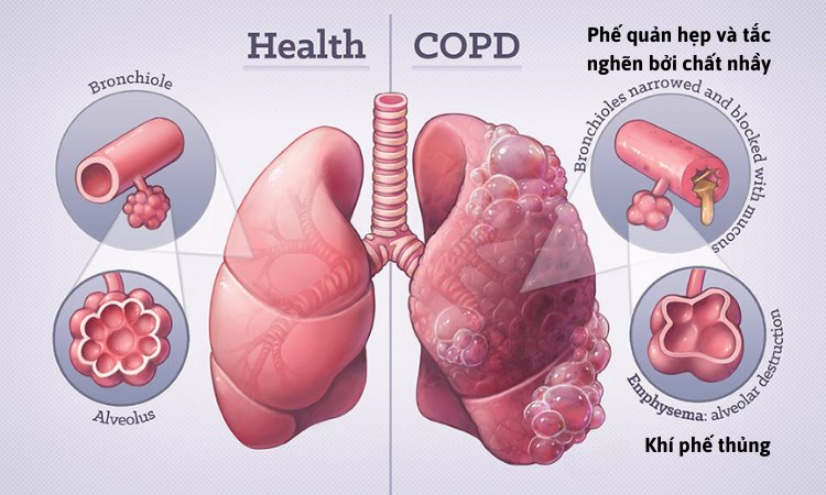 hinh-anh-cua-COPD.jpg