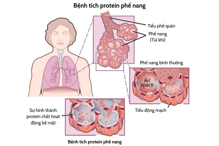 Benh-tich-protein-phe-nang.jpg